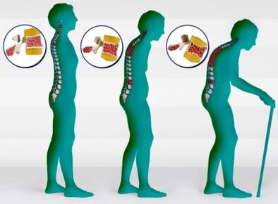 Osteoporosia